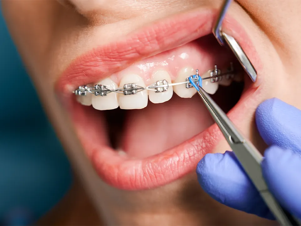 Orthodontics Braces